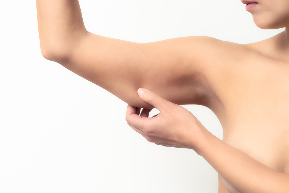 Woman pinching underarm fat promoting CoolSculpting treatment for arms