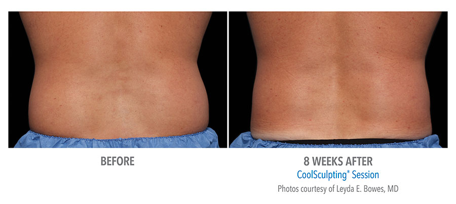 Before and after CoolSculpting treatment on man's lower back after 8 weeks by Dr. Leyda E. Bowles