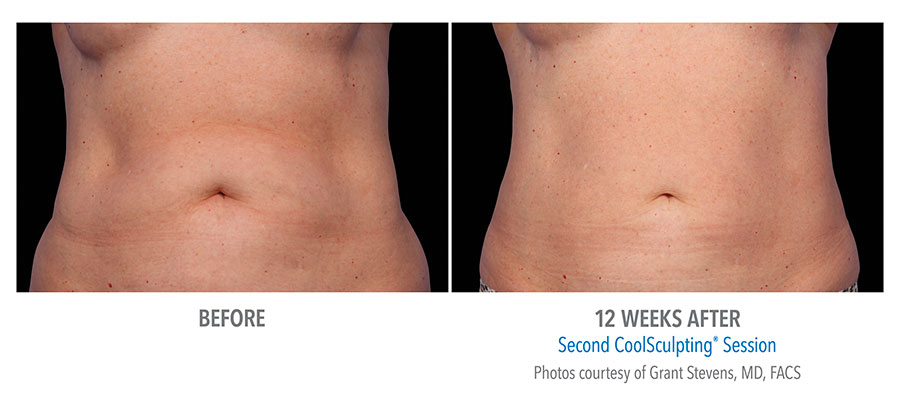 Before and after CoolSculpting treatment on a person's stomach and abs after 12 weeks by Dr. Grant Stevens