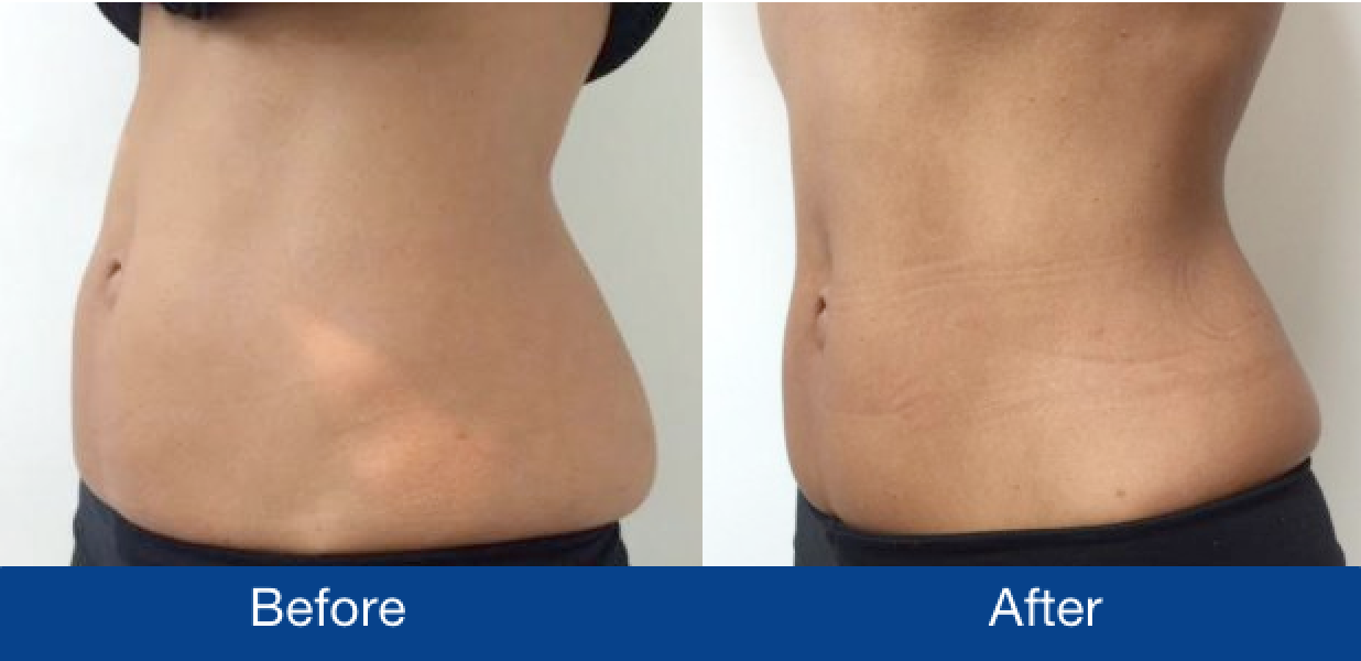 Before and after CoolSculpting treatment on woman's stomach and lower back