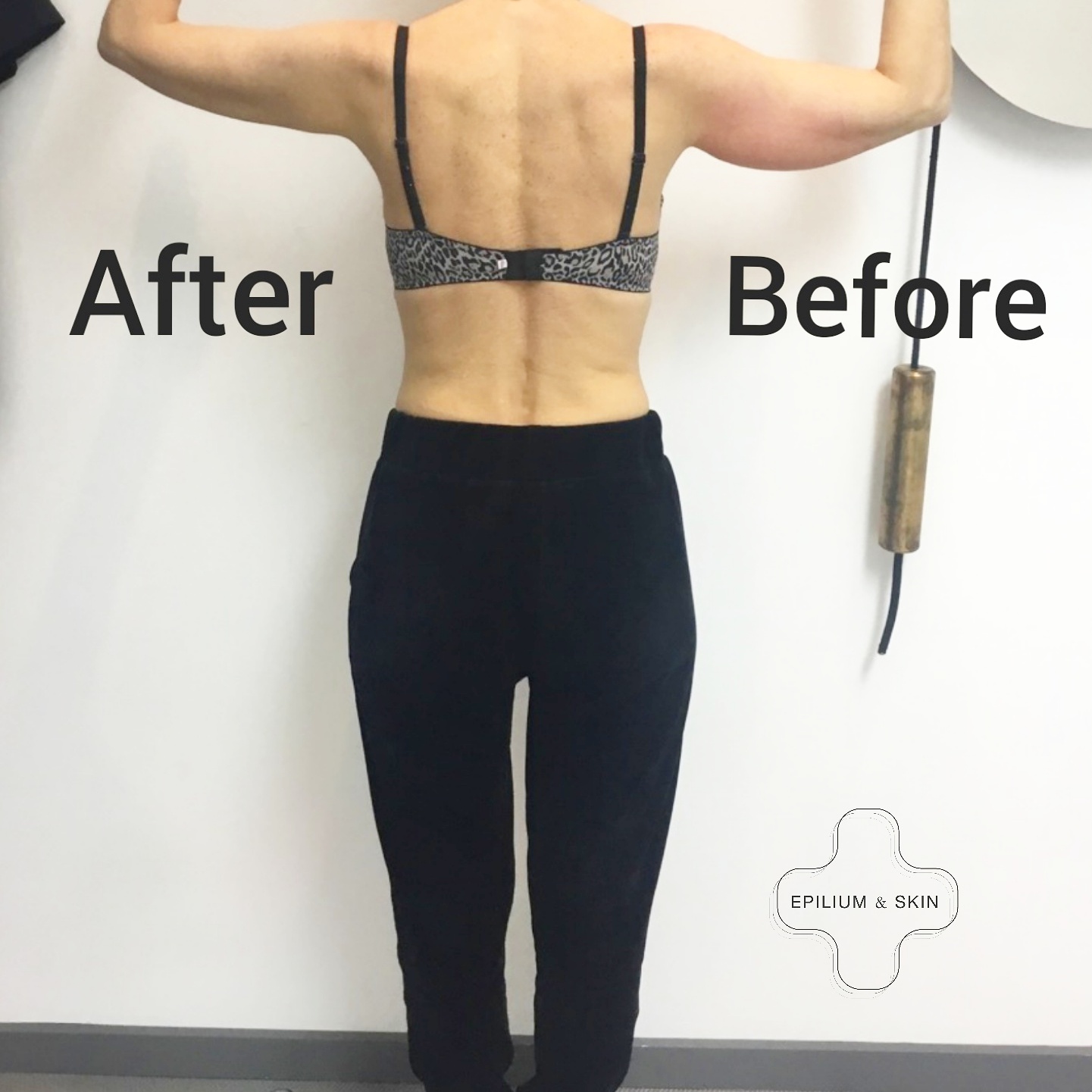 Before and after CoolSculpting treatment on woman's under arm and back