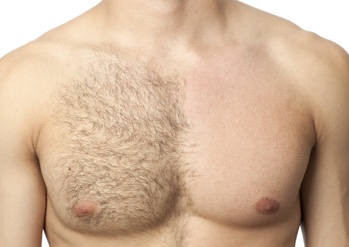 Man's chest showing laser hair removal treatment results on one side of chest 