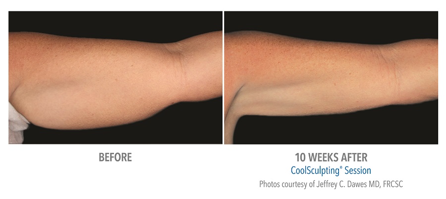 10 weeks before and after CoolSculpting treatment for arms by Dr. Jeffery C. Dawes