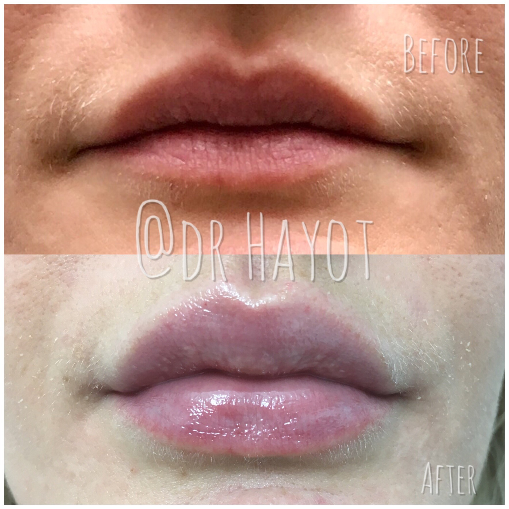 Before and after lip hyaluronic acid injection