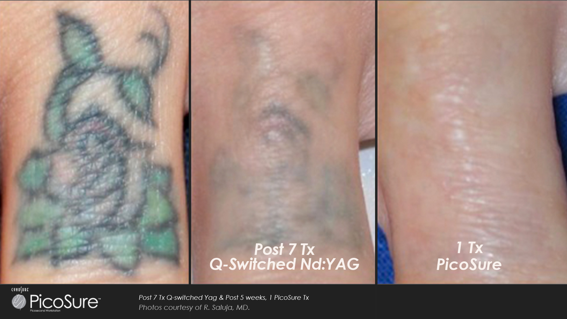 Laser Tattoo Removal with PicoSure Before & After