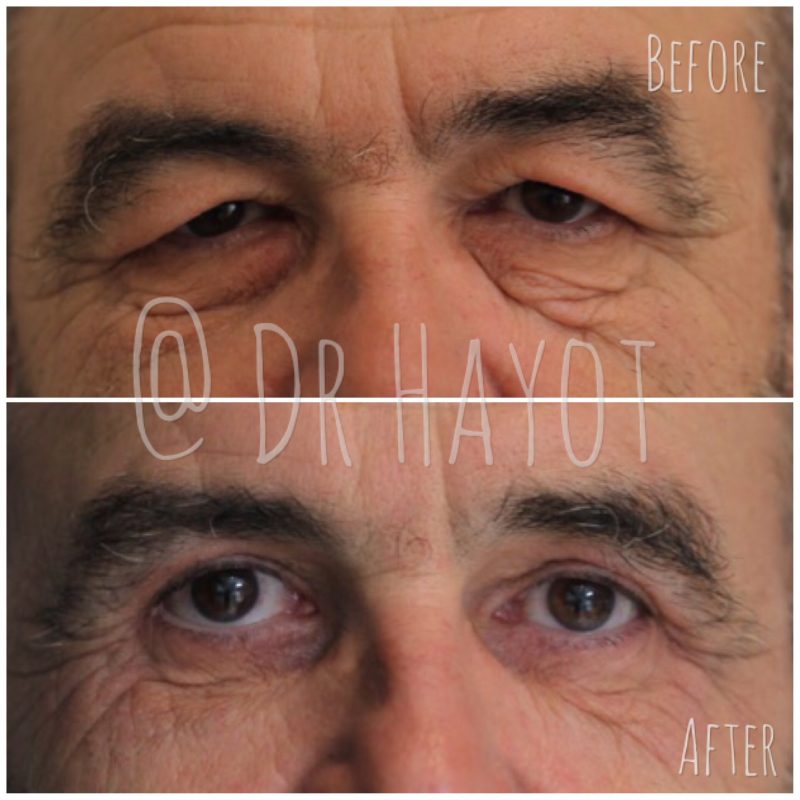 lower eyelid surgery uk