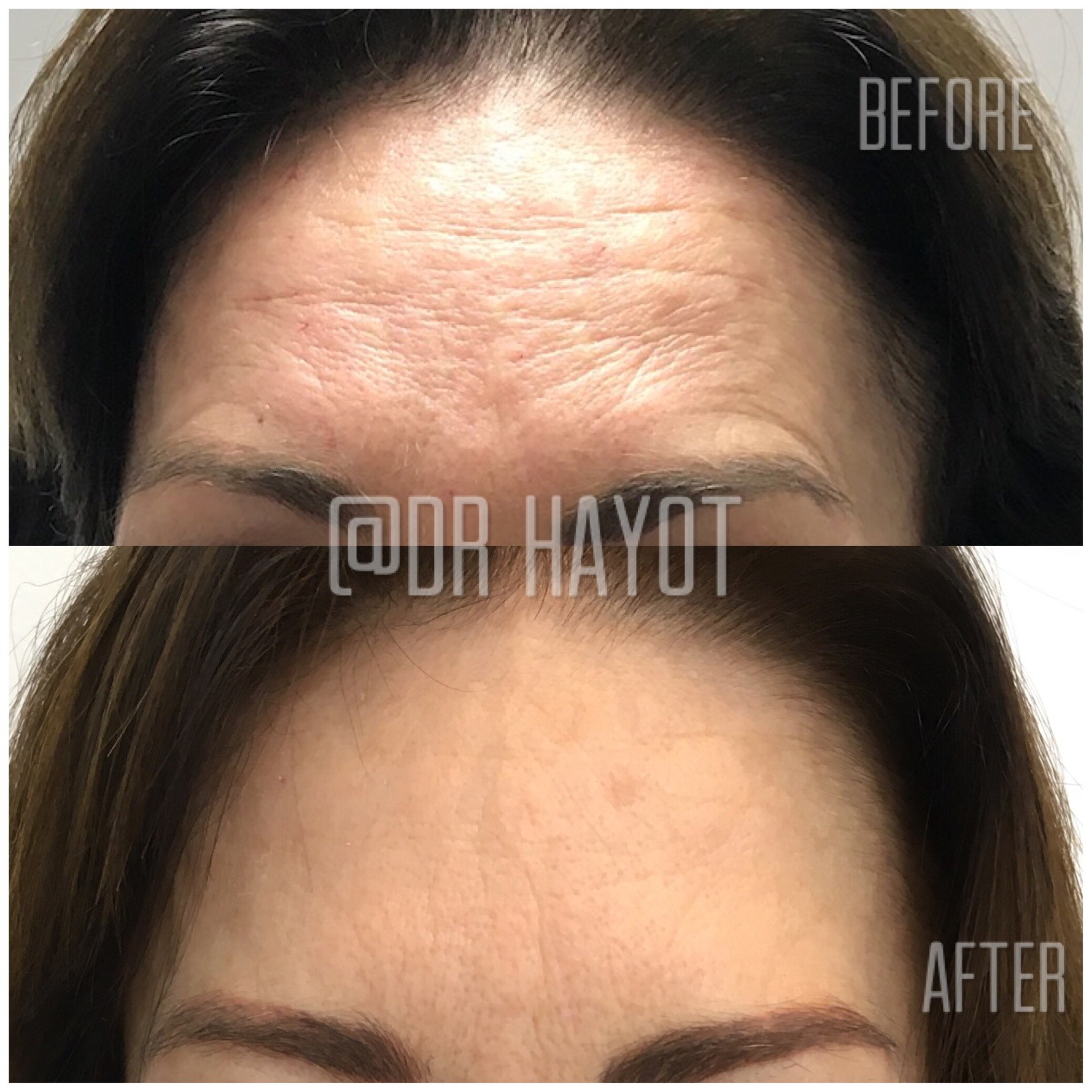 Before and after of woman's forehead after anti wrinkle micro needle injection